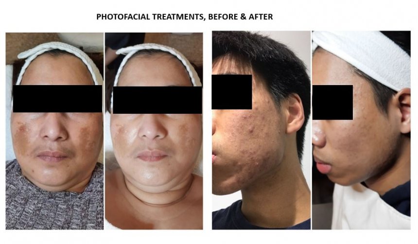 Photofacial before & after photos